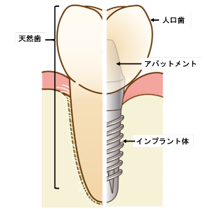 インプラント術前検査及び治療計画説明