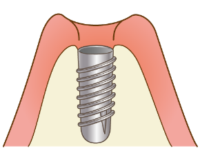 インプラント1次手術