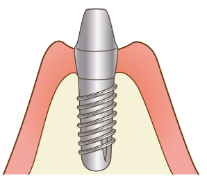 インプラント2次手術
